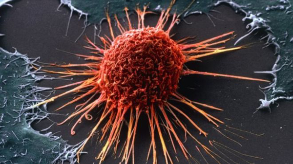 Ditemukan obat baru "yang efektif sembuhkan" pasien kanker stadium lanjut